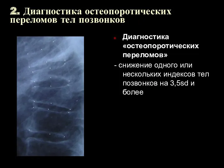 2. Диагностика остеопоротических переломов тел позвонков Диагностика «остеопоротических переломов» -