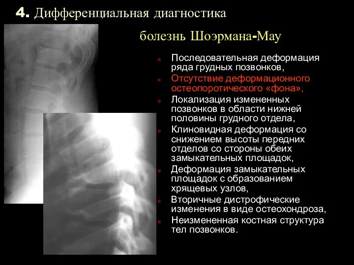 4. Дифференциальная диагностика болезнь Шоэрмана-Мау Последовательная деформация ряда грудных позвонков,