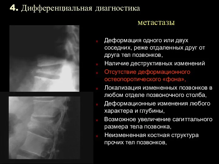 4. Дифференциальная диагностика метастазы Деформация одного или двух соседних, реже