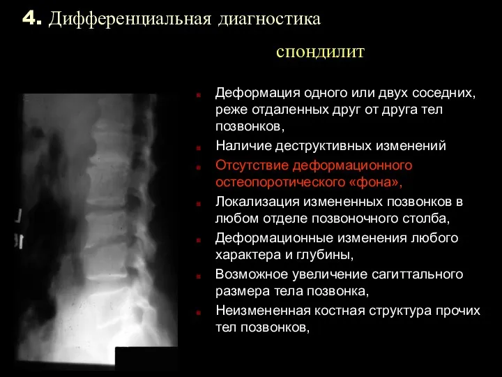 4. Дифференциальная диагностика спондилит Деформация одного или двух соседних, реже