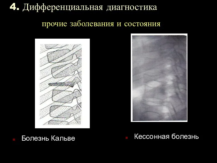 4. Дифференциальная диагностика прочие заболевания и состояния Болезнь Кальве Кессонная болезнь