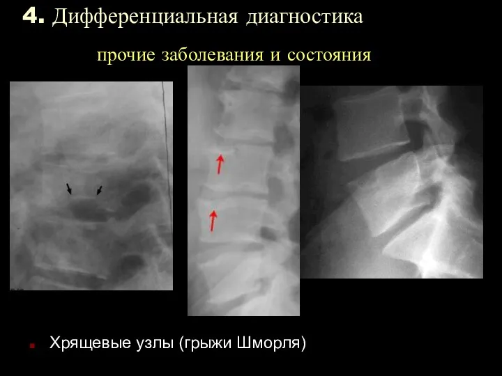 4. Дифференциальная диагностика прочие заболевания и состояния Хрящевые узлы (грыжи Шморля)