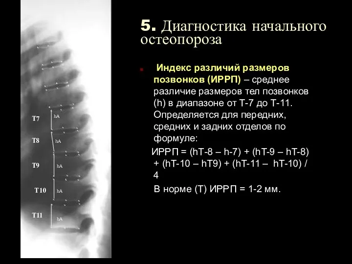 5. Диагностика начального остеопороза Индекс различий размеров позвонков (ИРРП) –