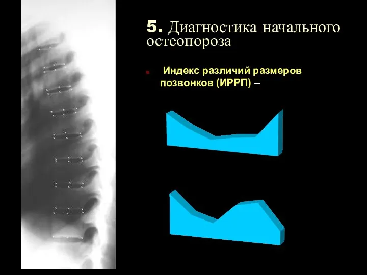 5. Диагностика начального остеопороза Индекс различий размеров позвонков (ИРРП) – Мужчины Женщины