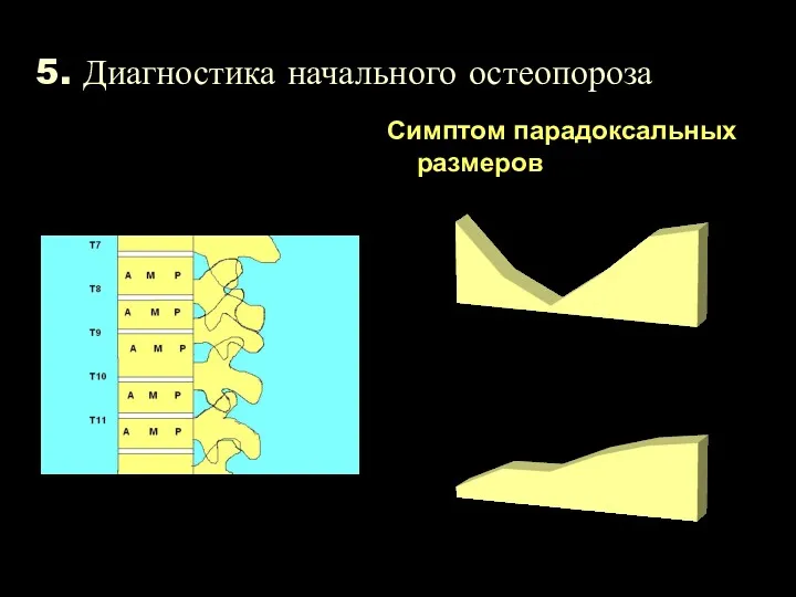 5. Диагностика начального остеопороза Симптом парадоксальных размеров Мужчины Женщины