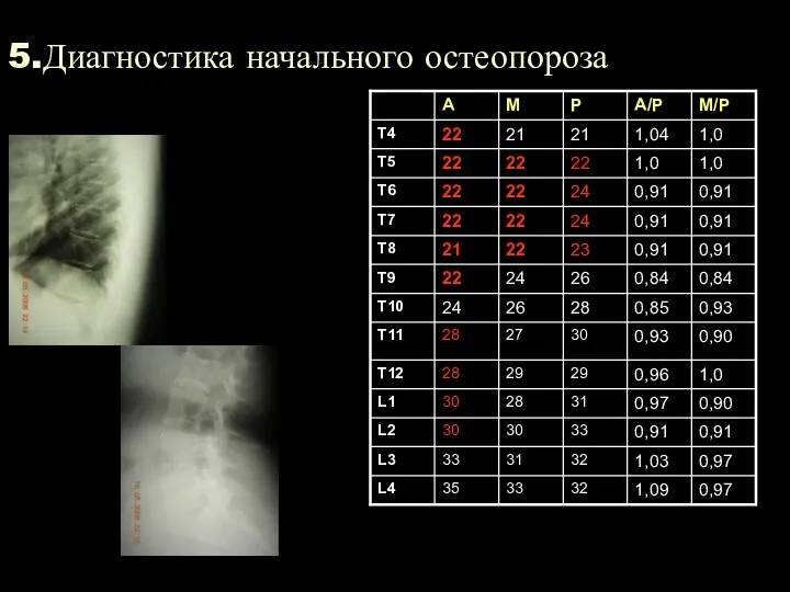 5.Диагностика начального остеопороза