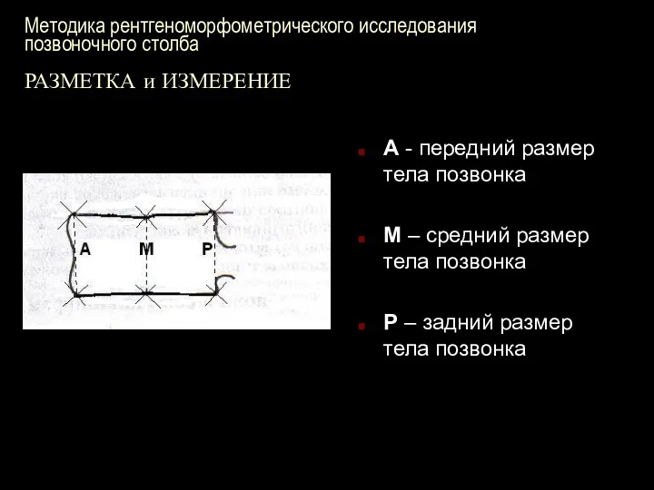 Методика рентгеноморфометрического исследования позвоночного столба РАЗМЕТКА и ИЗМЕРЕНИЕ А -