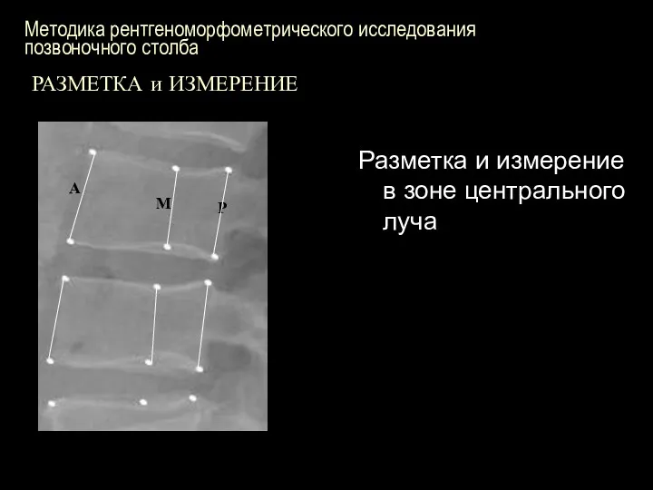 Методика рентгеноморфометрического исследования позвоночного столба РАЗМЕТКА и ИЗМЕРЕНИЕ Разметка и