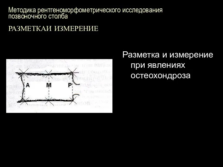 Методика рентгеноморфометрического исследования позвоночного столба РАЗМЕТКАИ ИЗМЕРЕНИЕ Разметка и измерение при явлениях остеохондроза М Р