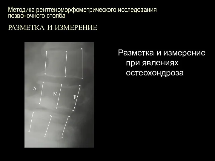 Методика рентгеноморфометрического исследования позвоночного столба РАЗМЕТКА И ИЗМЕРЕНИЕ Разметка и