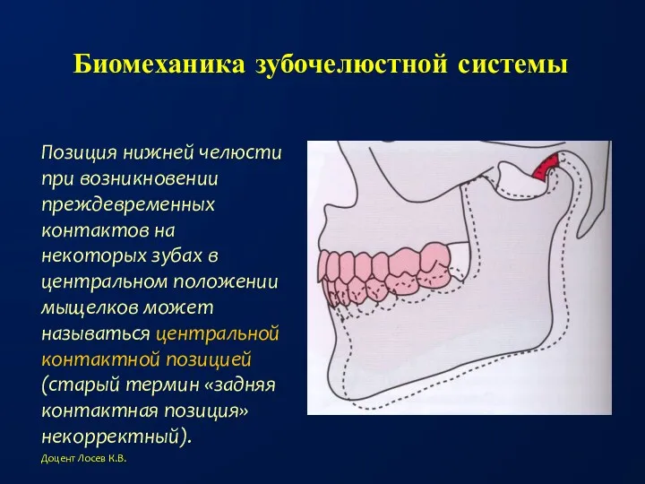 Биомеханика зубочелюстной системы Позиция нижней челюсти при возникновении преждевременных контактов на некоторых зубах