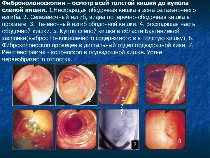Фиброколоноскопия – осмотр всей толстой кишки до купола слепой кишки. 1.Нисходящая ободочная кишка