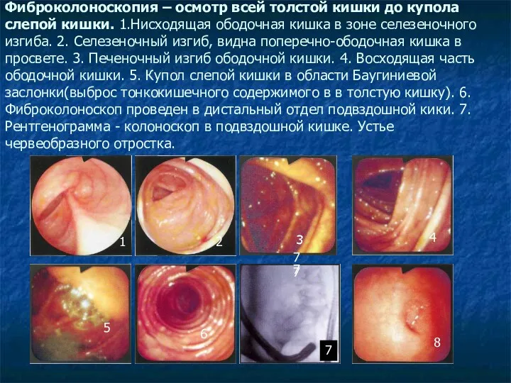 Фиброколоноскопия – осмотр всей толстой кишки до купола слепой кишки.