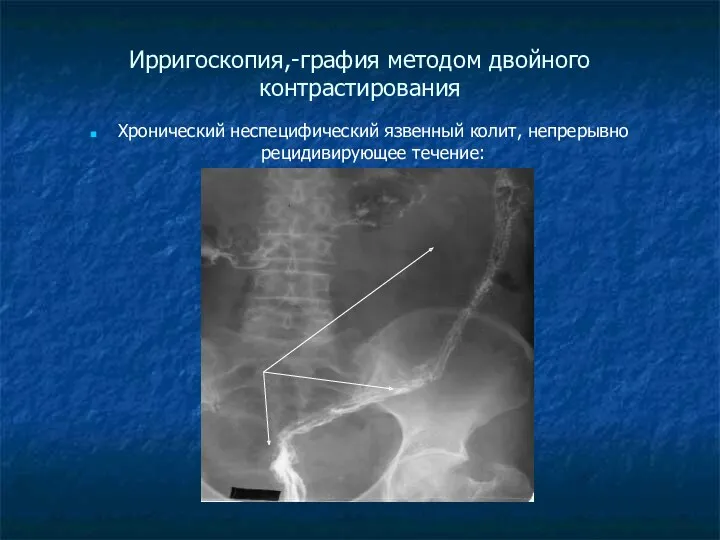 Ирригоскопия,-графия методом двойного контрастирования Хронический неспецифический язвенный колит, непрерывно рецидивирующее течение: