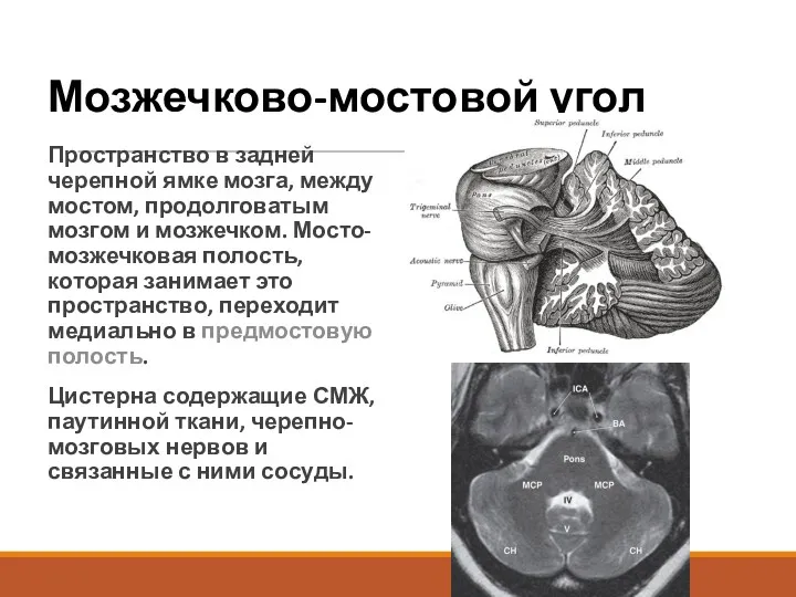 Мозжечково-мостовой угол Пространство в задней черепной ямке мозга, между мостом, продолговатым мозгом и