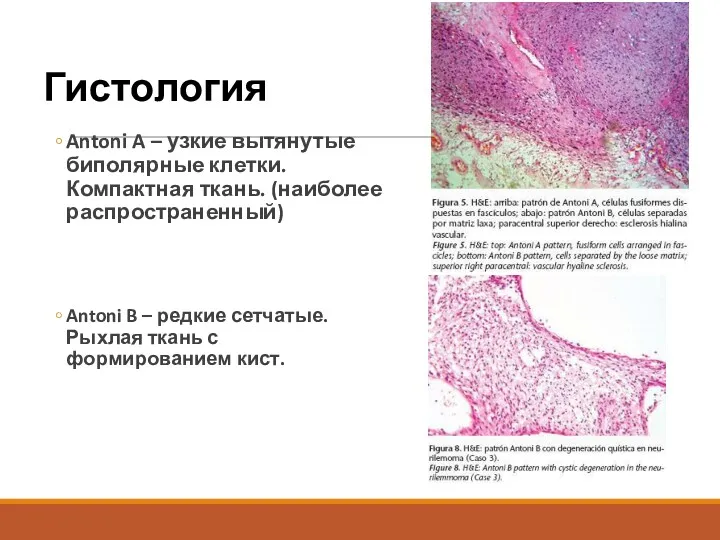 Гистология Antoni A – узкие вытянутые биполярные клетки. Компактная ткань. (наиболее распространенный) Antoni