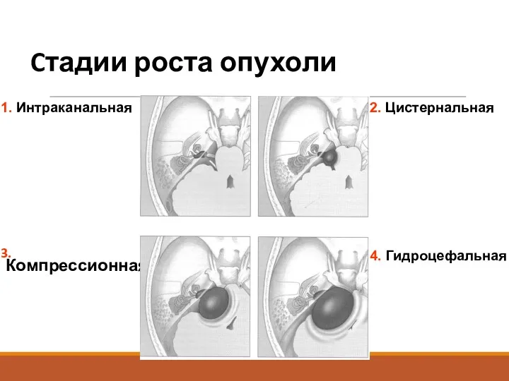 Cтадии роста опухоли 3. Компрессионная 1. Интраканальная 2. Цистернальная 4. Гидроцефальная