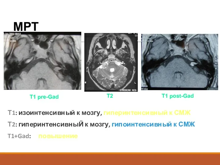 МРТ Т1: изоинтенсивный к мозгу, гиперинтенсивный к СМЖ Т2: гиперинтенсивныЙ к мозгу, гипоинтенсивный