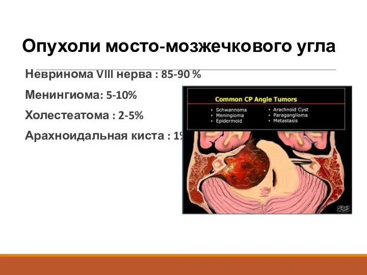 Опухоли мосто-мозжечкового угла Невринома VIII нерва : 85-90 % Менингиома: 5-10% Холестеатома :