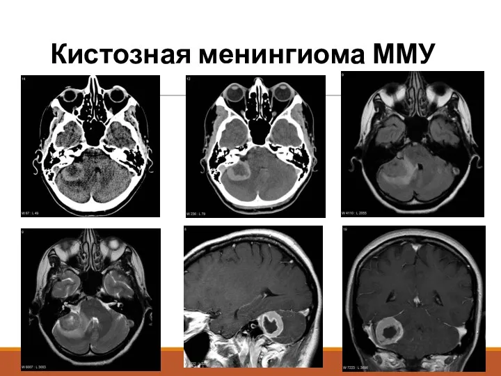 Кистозная менингиома ММУ