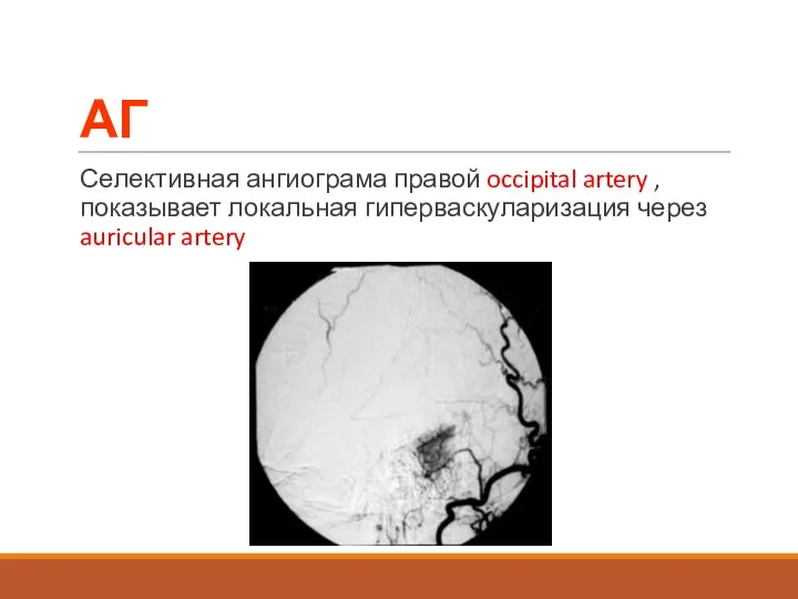 АГ Селективная ангиограма правой occipital artery , показывает локальная гиперваскуларизация через auricular artery