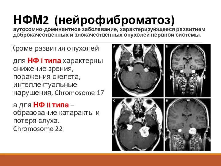 НФМ2 (нейрофиброматоз) аутосомно-доминантное заболевание, характеризующееся развитием доброкачественных и злокачественных опухолей