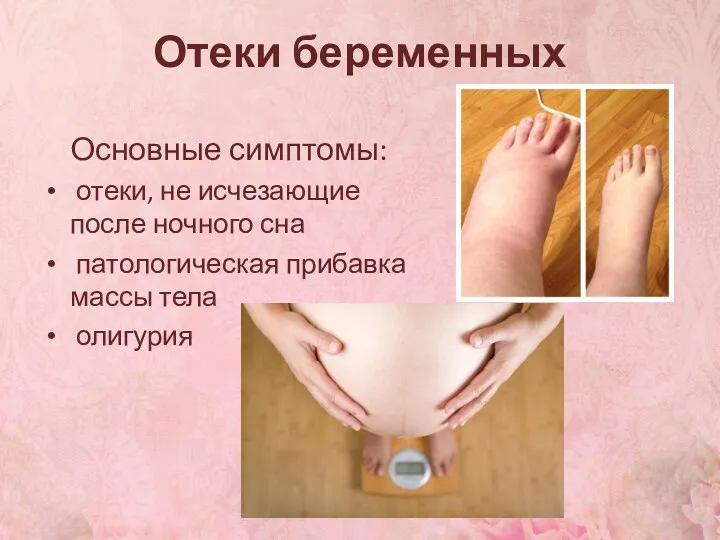 Основные симптомы: отеки, не исчезающие после ночного сна патологическая прибавка массы тела олигурия Отеки беременных