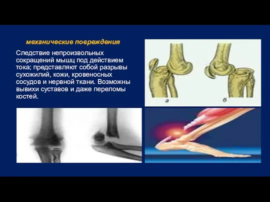 механические повреждения Следствие непроизвольных сокращений мышц под действием тока; представляют