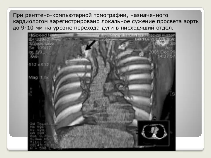 При рентгено-компьютерной томографии, назначенного кардиологом зарегистрировано локальное сужение просвета аорты до 9-10 мм