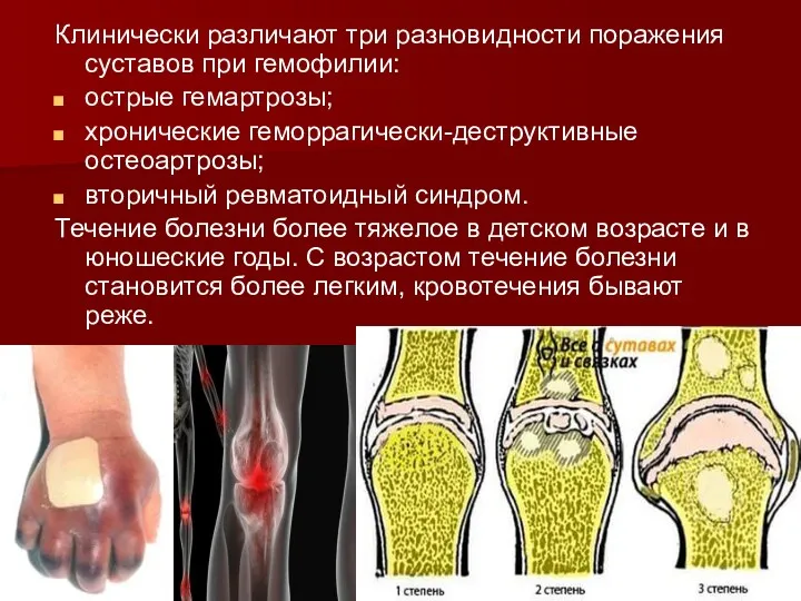 Клинически различают три разновидности поражения суставов при гемофилии: острые гемартрозы;