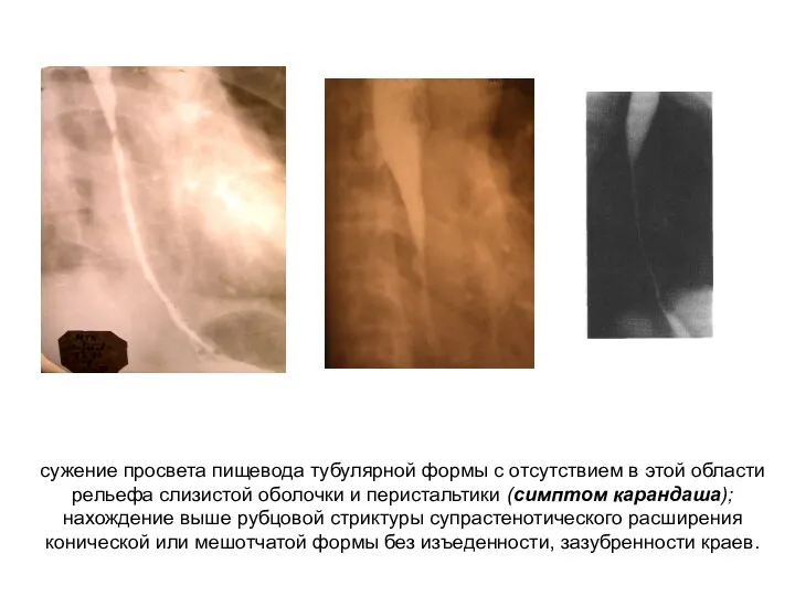 сужение просвета пищевода тубулярной формы с отсутствием в этой области