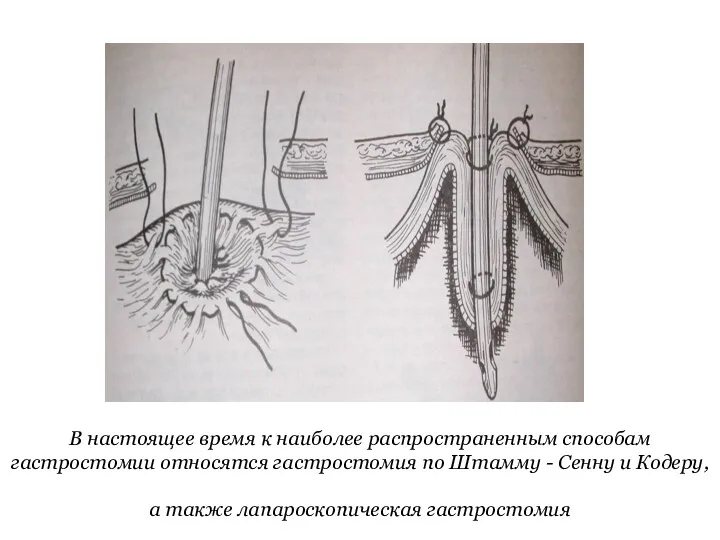 В настоящее время к наиболее распространенным способам гастростомии относятся гастростомия