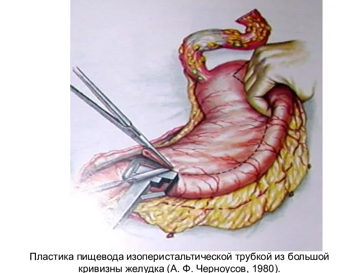 Пластика пищевода изоперистальтической трубкой из большой кривизны желудка (А. Ф. Черноусов, 1980).