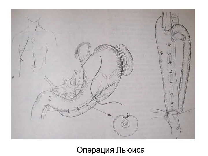 Операция Льюиса