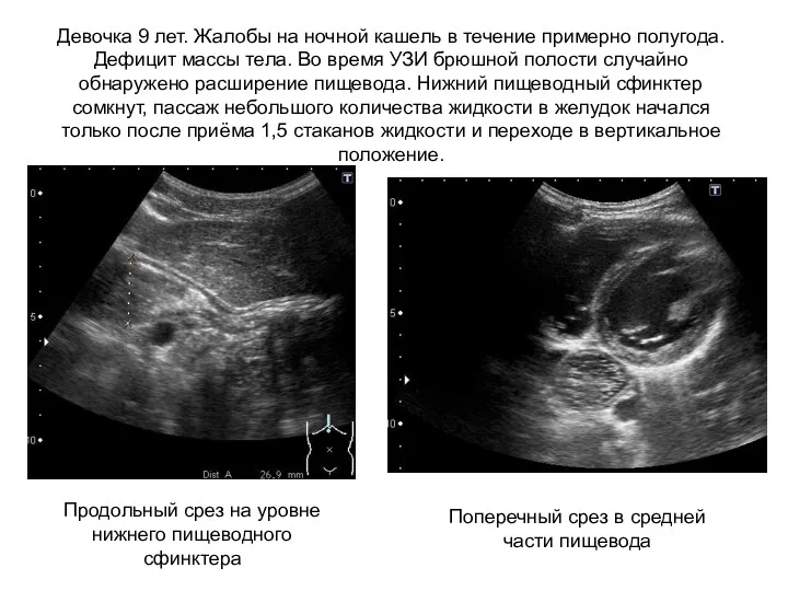 Девочка 9 лет. Жалобы на ночной кашель в течение примерно