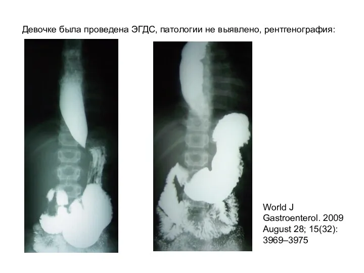 Девочке была проведена ЭГДС, патологии не выявлено, рентгенография: World J Gastroenterol. 2009 August 28; 15(32): 3969–3975