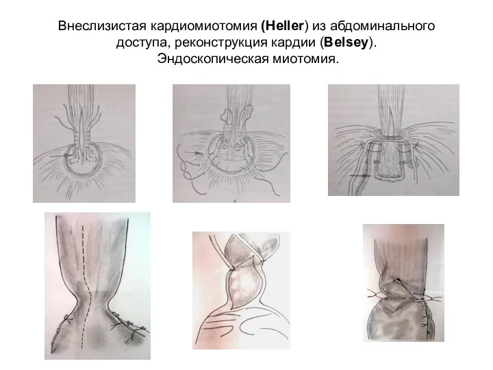 Внеслизистая кардиомиотомия (Heller) из абдоминального доступа, реконструкция кардии (Belsey). Эндоскопическая миотомия.