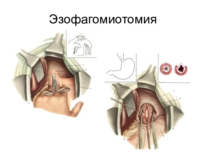 Эзофагомиотомия