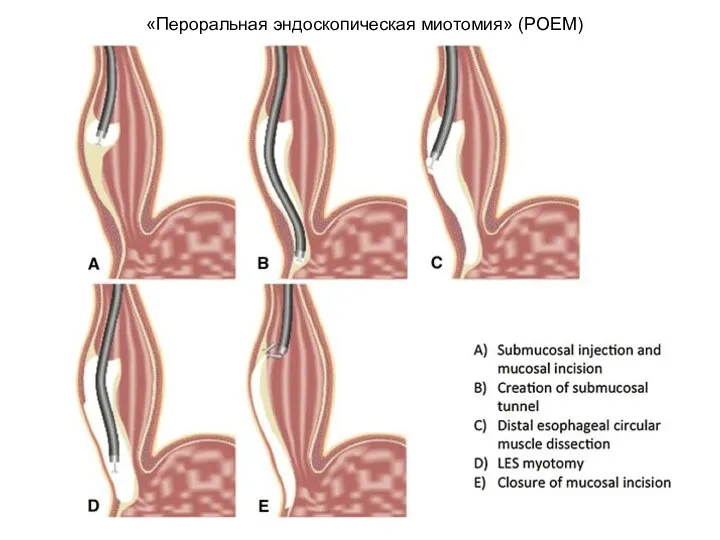 «Пероральная эндоскопическая миотомия» (POEM)