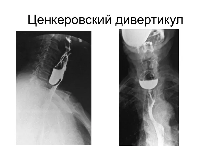 Ценкеровский дивертикул