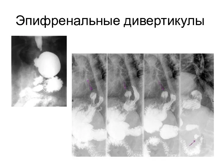 Эпифренальные дивертикулы