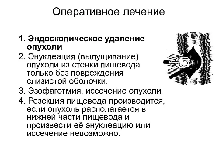 Оперативное лечение 1. Эндоскопическое удаление опухоли 2. Энуклеация (вылущивание) опухоли