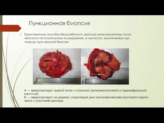 Пункционная биопсия Единственным способом безошибочного диагноза ангиомиолипомы почки явля-ется гистологическое