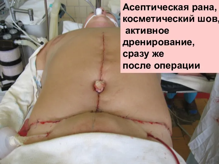 Асептическая рана, косметический шов, активное дренирование, сразу же после операции