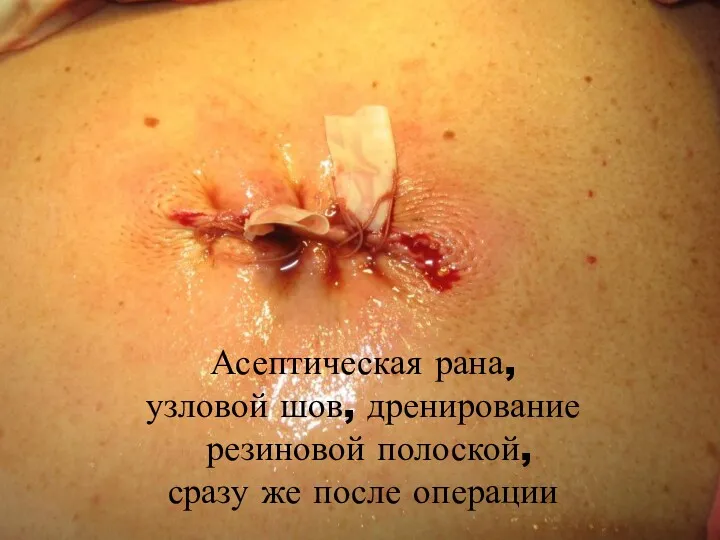 Асептическая рана, узловой шов, дренирование резиновой полоской, сразу же после операции