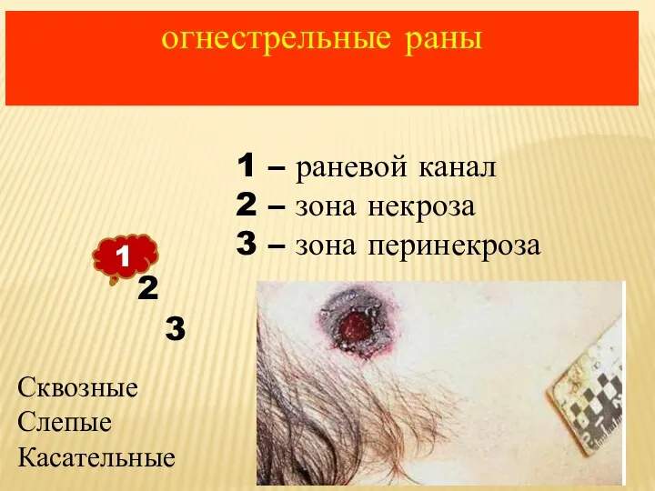 огнестрельные раны 1 2 3 1 – раневой канал 2 – зона некроза