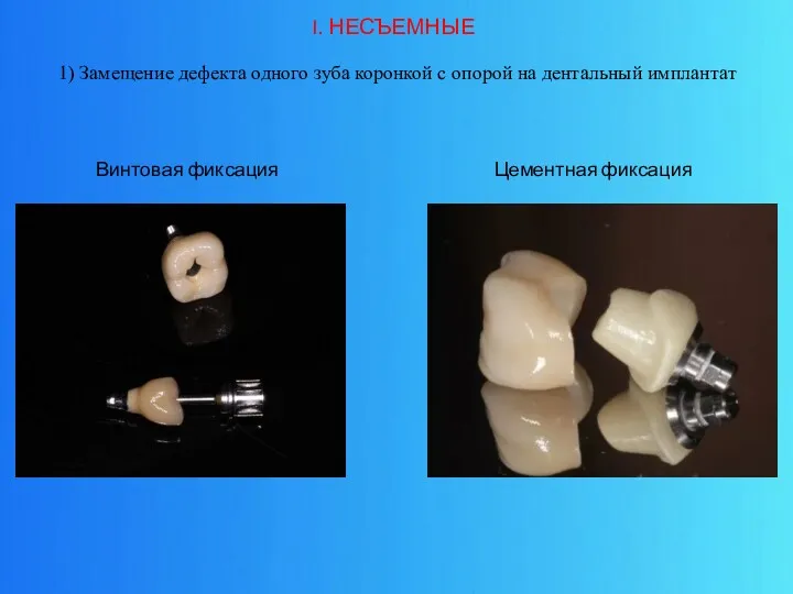 1) Замещение дефекта одного зуба коронкой с опорой на дентальный