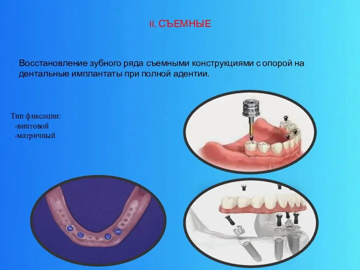 II. СЪЕМНЫЕ Восстановление зубного ряда съемными конструкциями с опорой на