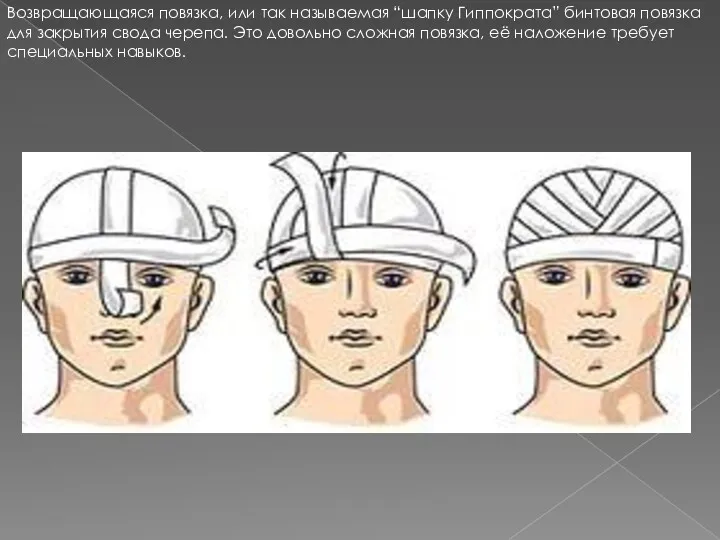 Возвращающаяся повязка, или так называемая “шапку Гиппократа” бинтовая повязка для