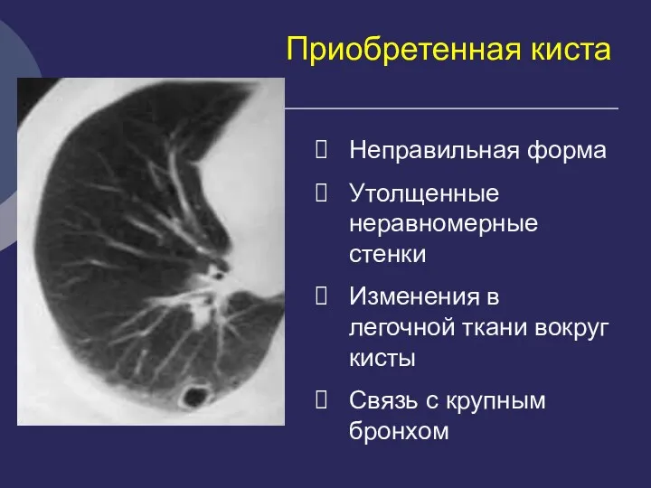 Приобретенная киста Неправильная форма Утолщенные неравномерные стенки Изменения в легочной